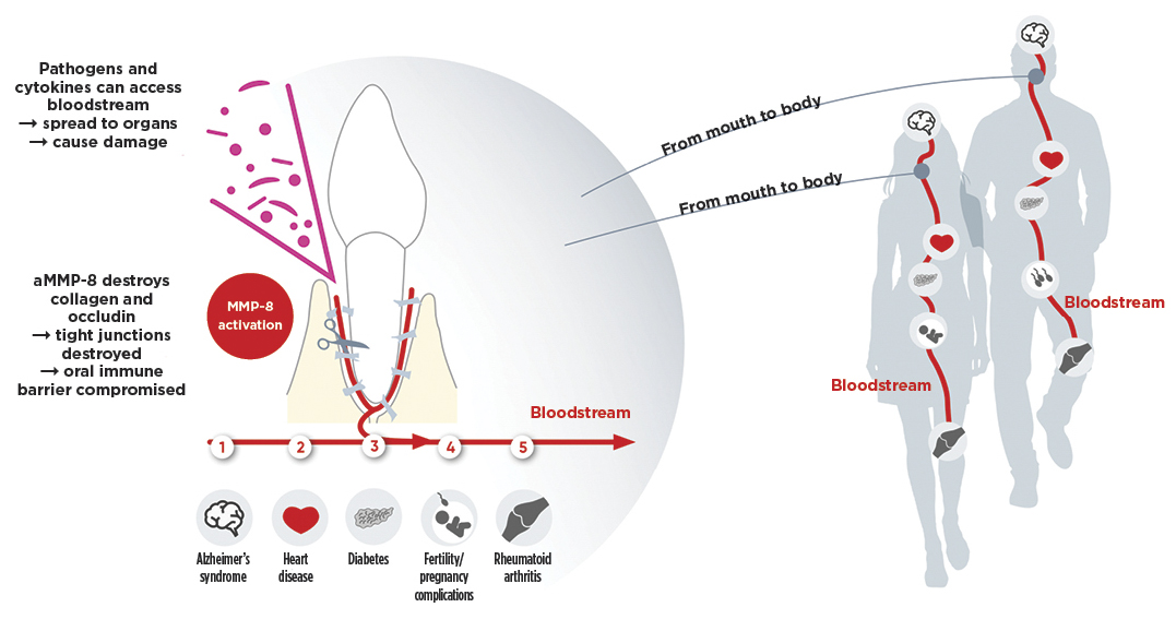 Leaky Gum Syndrome and the Mouth-Body Connection: The Impact of Oral