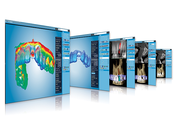 Precise, Efficient Implant Placement Utilizing CAD/CAM and Digital ...