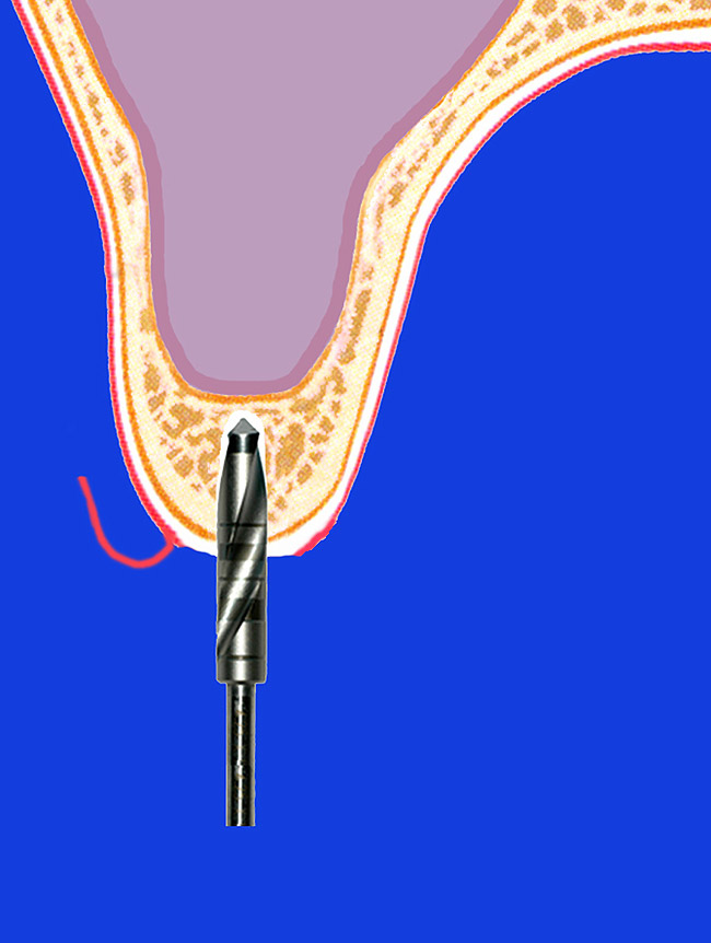 Bone-Added Osteotome Sinus Floor Elevation for the Deficient Maxillary ...