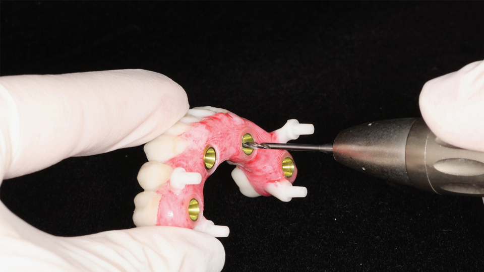 A Novel Method to Pick-up Prefabricated CAD/CAM-Designed Screw-Retained ...