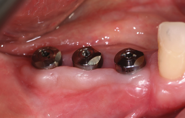 CAD/CAM Implant Abutments Using Coded Healing Abutments: A Detailed ...