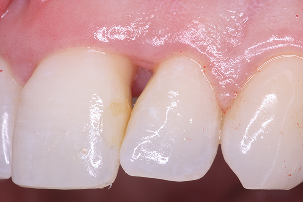 Restoration of Lost Interdental Papilla: A Surgical Restoration of Lost Interdental Papilla: A Surgical