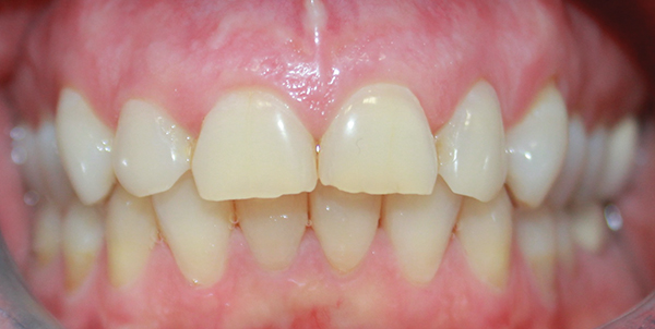 Simplifying the Impression-Taking Process for High-Quality